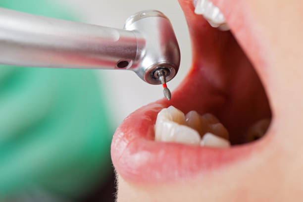 Best Emergency Treatment for Dental Infections or Abscesses in Ellenton, FL
